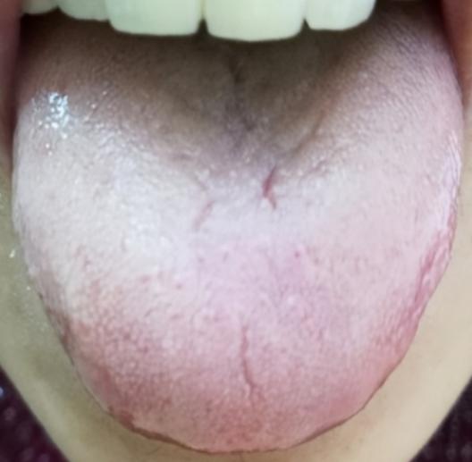 血虚裂纹，阳虚裂纹，阴虚裂纹，三个方，补血温阳滋阴，除裂纹

1、血虚----裂