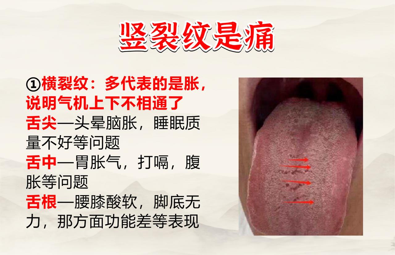 舌上裂纹，横代表“胀”，竖代表“痛”