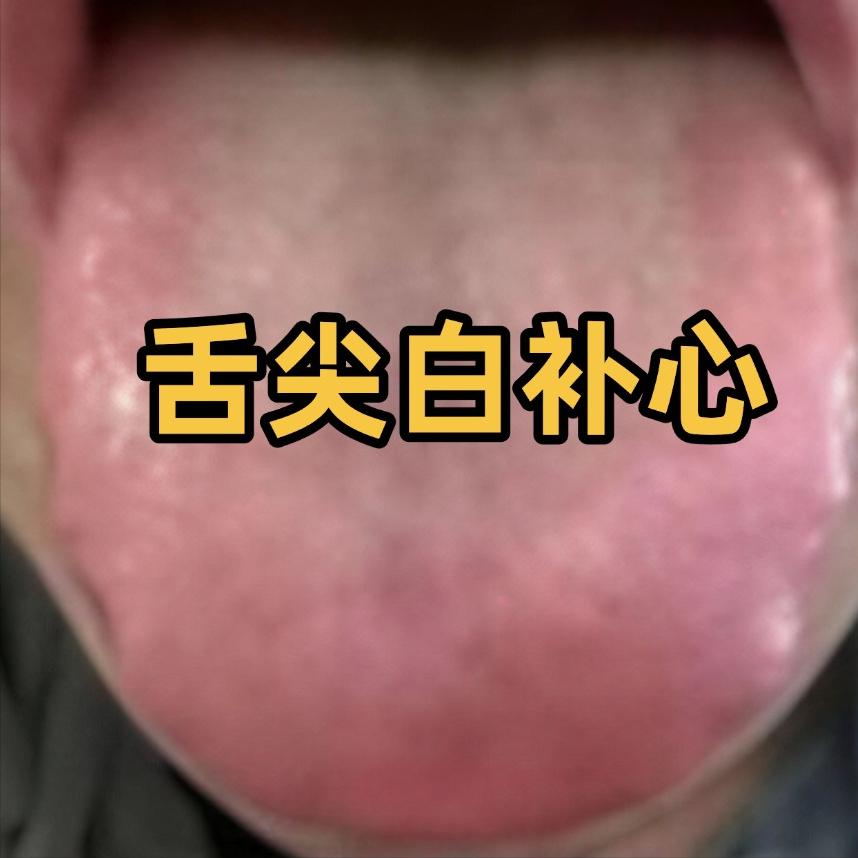 舌尖白补心、舌中白补脾、舌根白补肾，记住这个舌诊口诀！辨证进补不盲目

1.舌尖