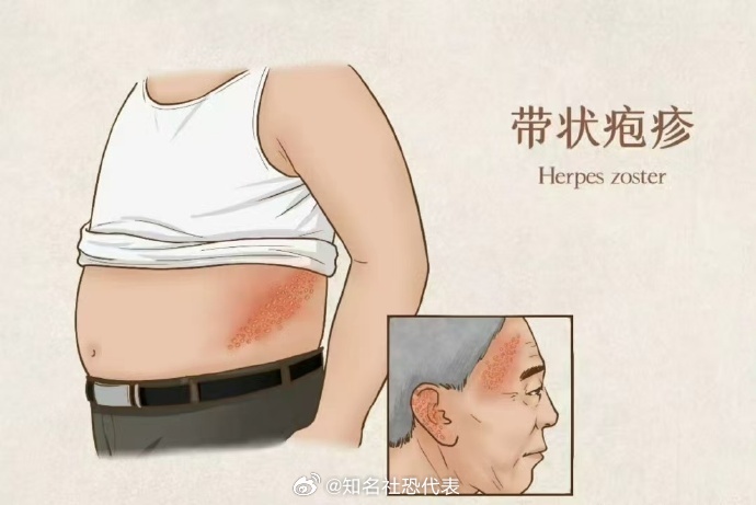 家里有三高人群警惕带状疱疹 腰上长一串疱还钻心地疼，赶紧看医生别硬扛！尤其提醒有