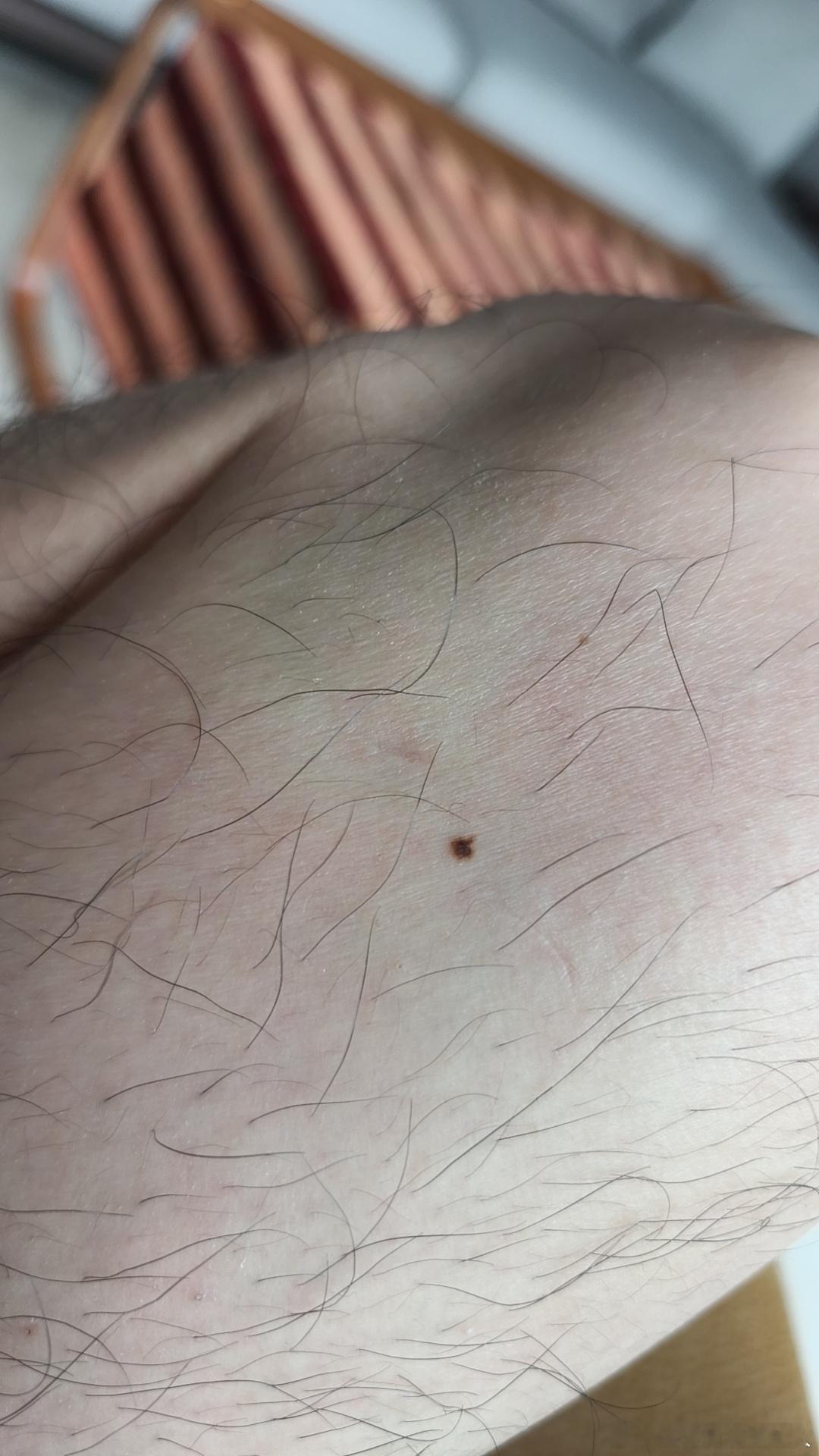 这颗痣变得越来越危险了，本来只是边缘不规整，现在长出了一条尾巴，从蛙卵变成了蝌蚪