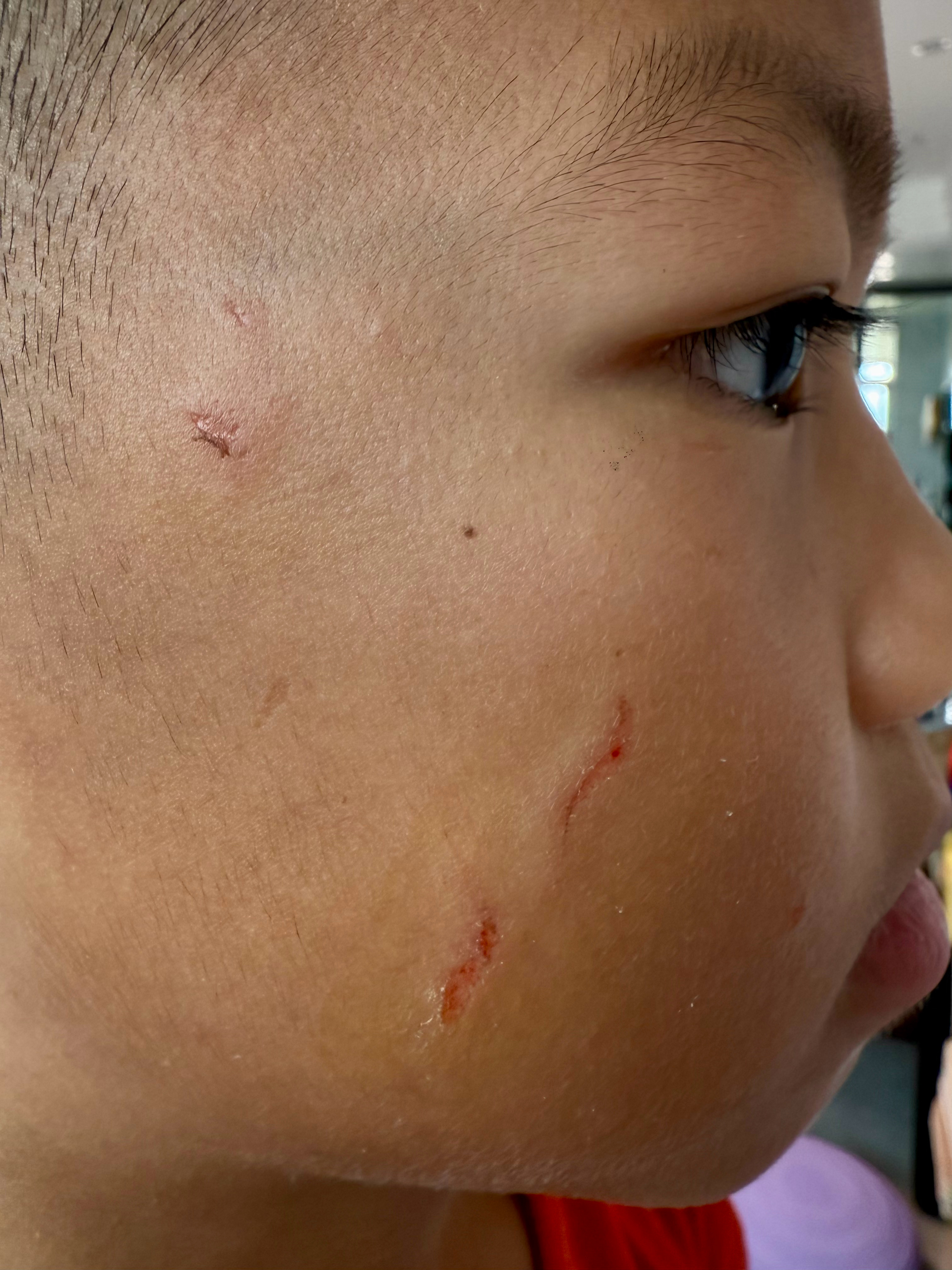 心累！小哥同表妹PK被KO，脸上这种伤口怎样才能不留疤？ ​​​