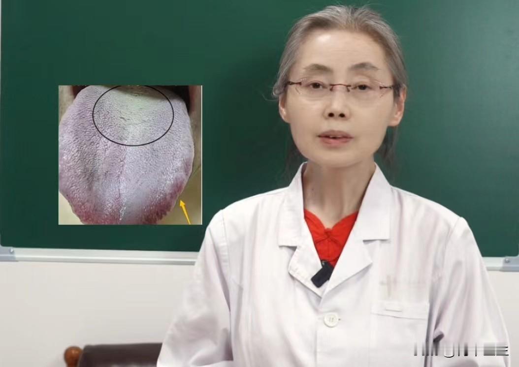 舌头白成这样，舌根却发黄，是怎么回事？

前一阵门诊接诊的一位30岁男性患者，主