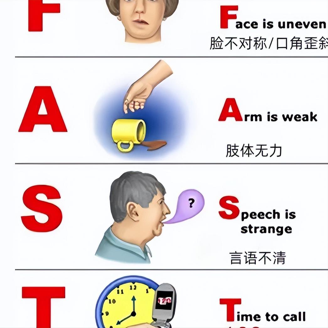 脑梗发作4.5小时，记住这4个字母，关键时候能救命！

F（Face）：笑一笑，