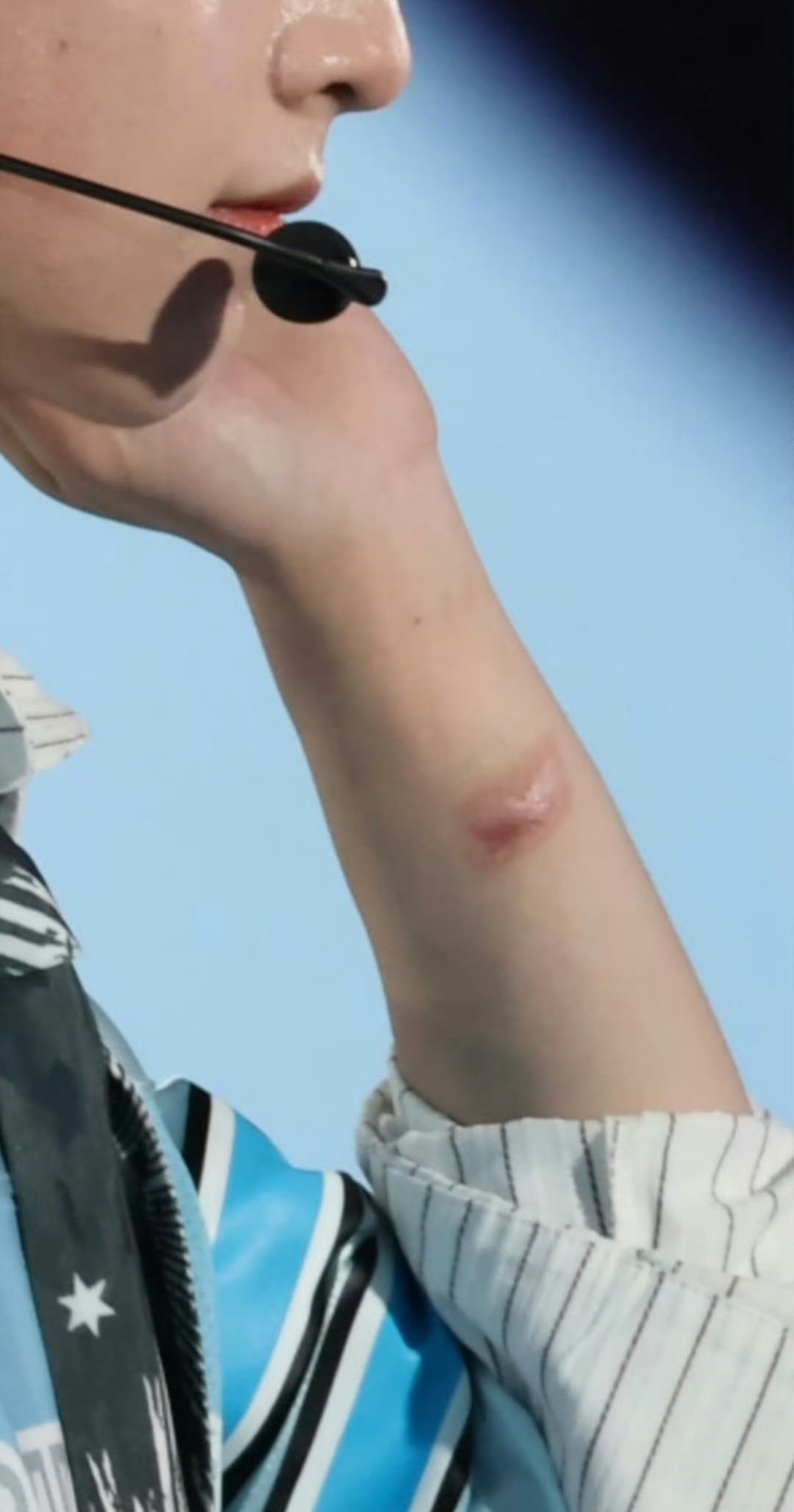 杨涵博胳膊烫伤杨涵博疑似胳膊烫伤 这是胳膊烫伤了吗？！ 