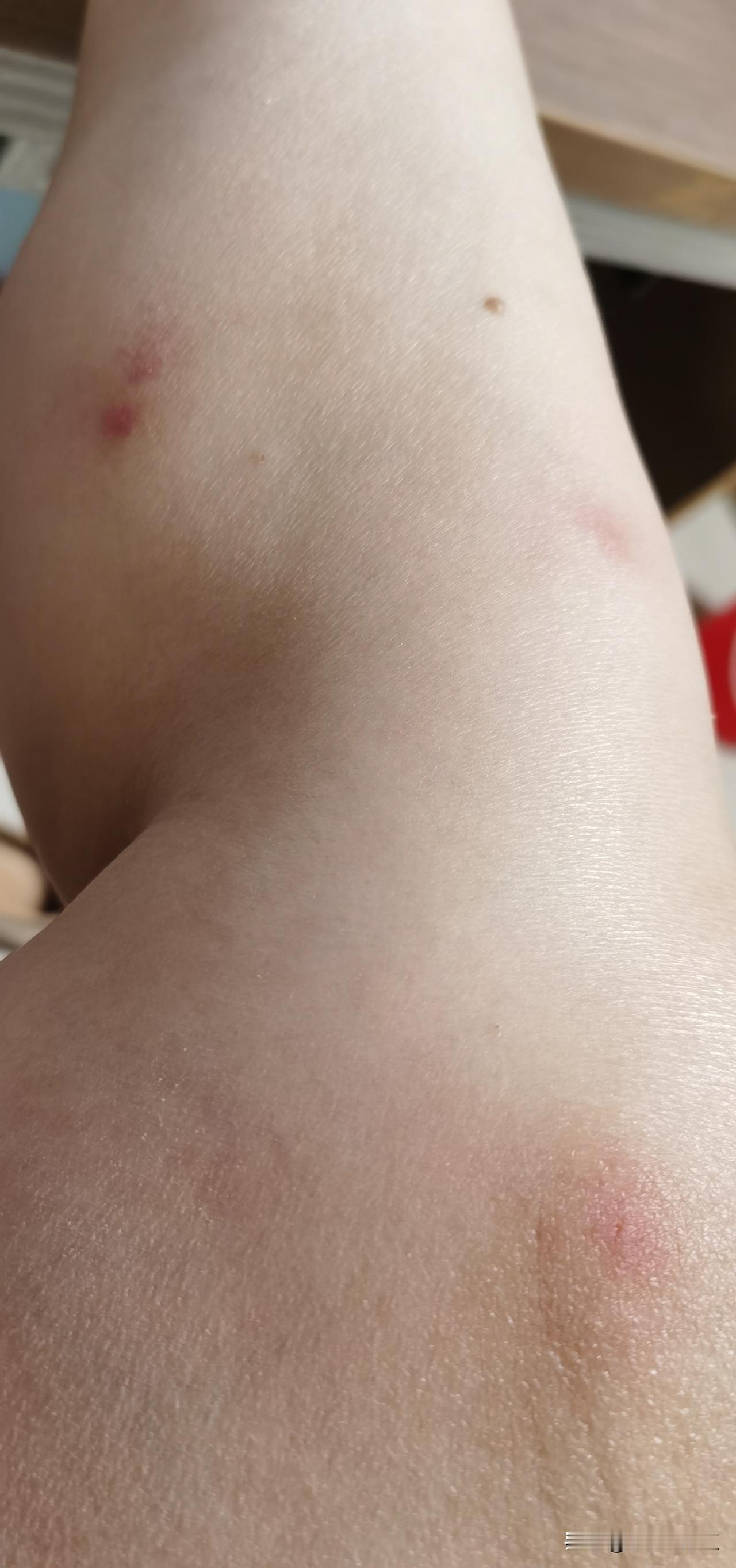 这年头对人对热情的就属蚊子了，一天送了我好几个大红包，包开始发红，痒得老想挠，买
