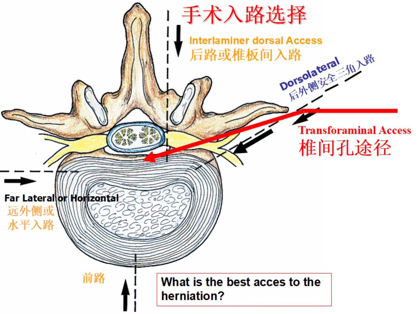 椎间盘游离脱垂手术过程。🔎现在把椎板间的黄韧带打开了，看到的是深层的...