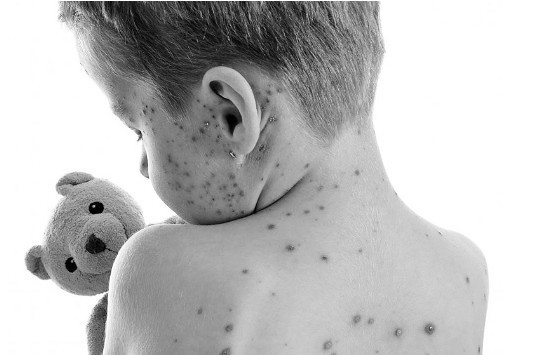 水痘通常潜伏期2周左右，感染初期可出现发热、乏力等不适症状，但比较轻微。发病1—