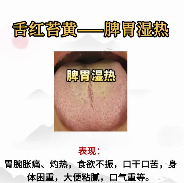 看舌辨脾虚：5 类核心证型全解析