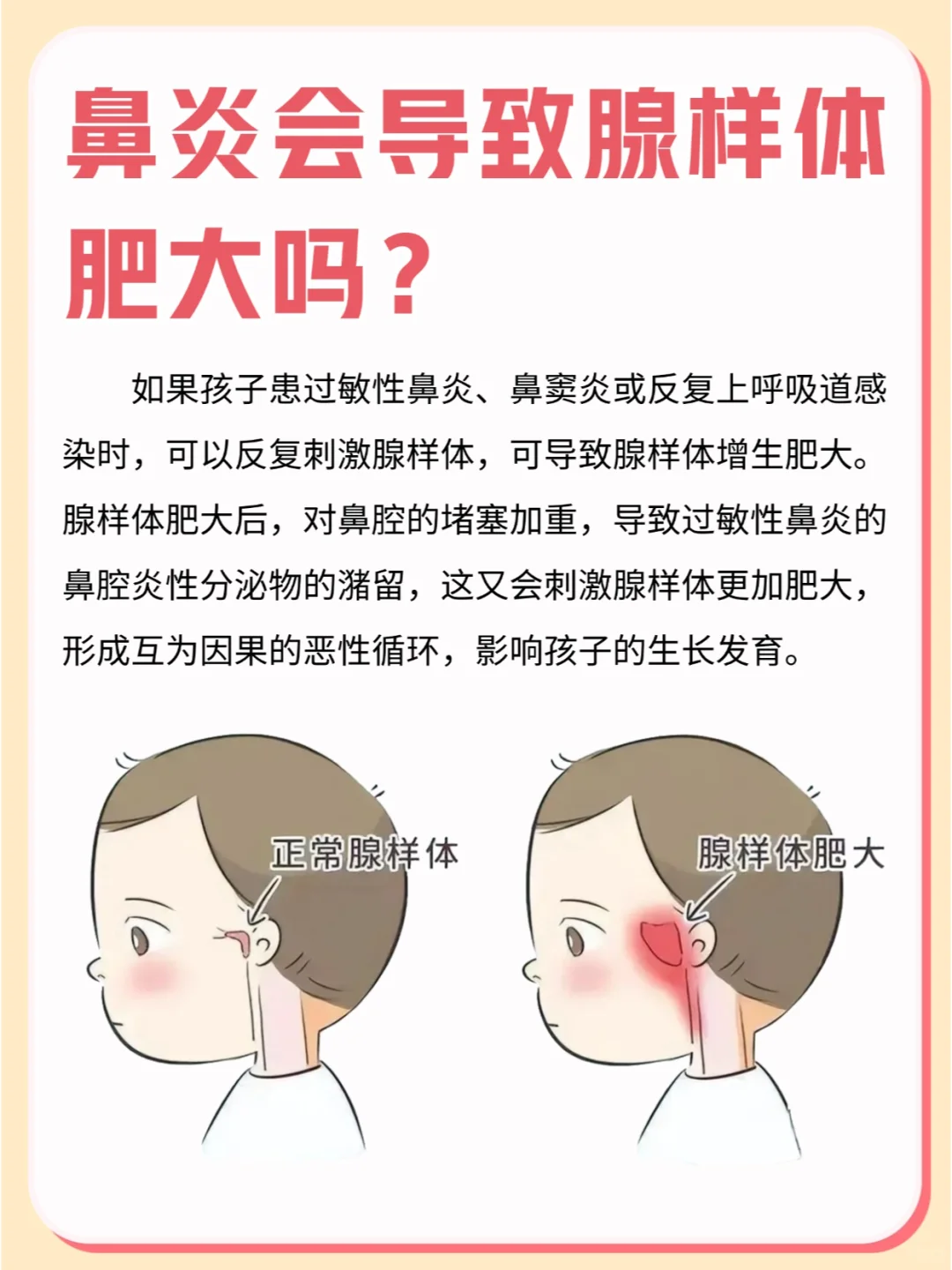 什么❓鼻炎还和腺样体有关系❗