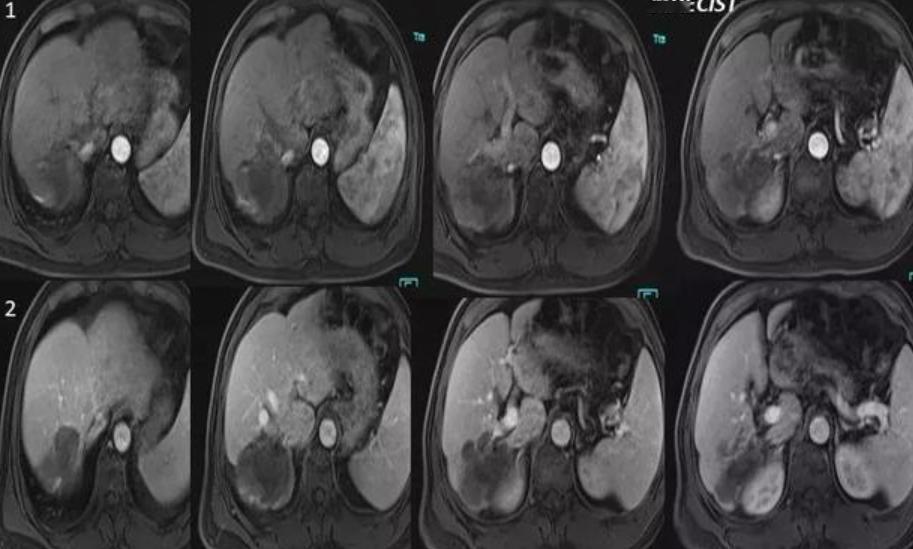 2025年3月7号晚上，我给二女儿洗澡，忽然摸到她肚子上有个肿起来的包块，按着硬