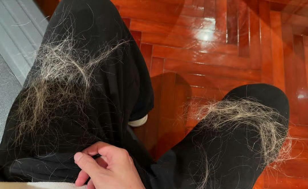 薛之谦满头斑秃和水泡 为了舞台完美，反复漂染头发，导致头皮灼伤起水泡，大片斑秃，