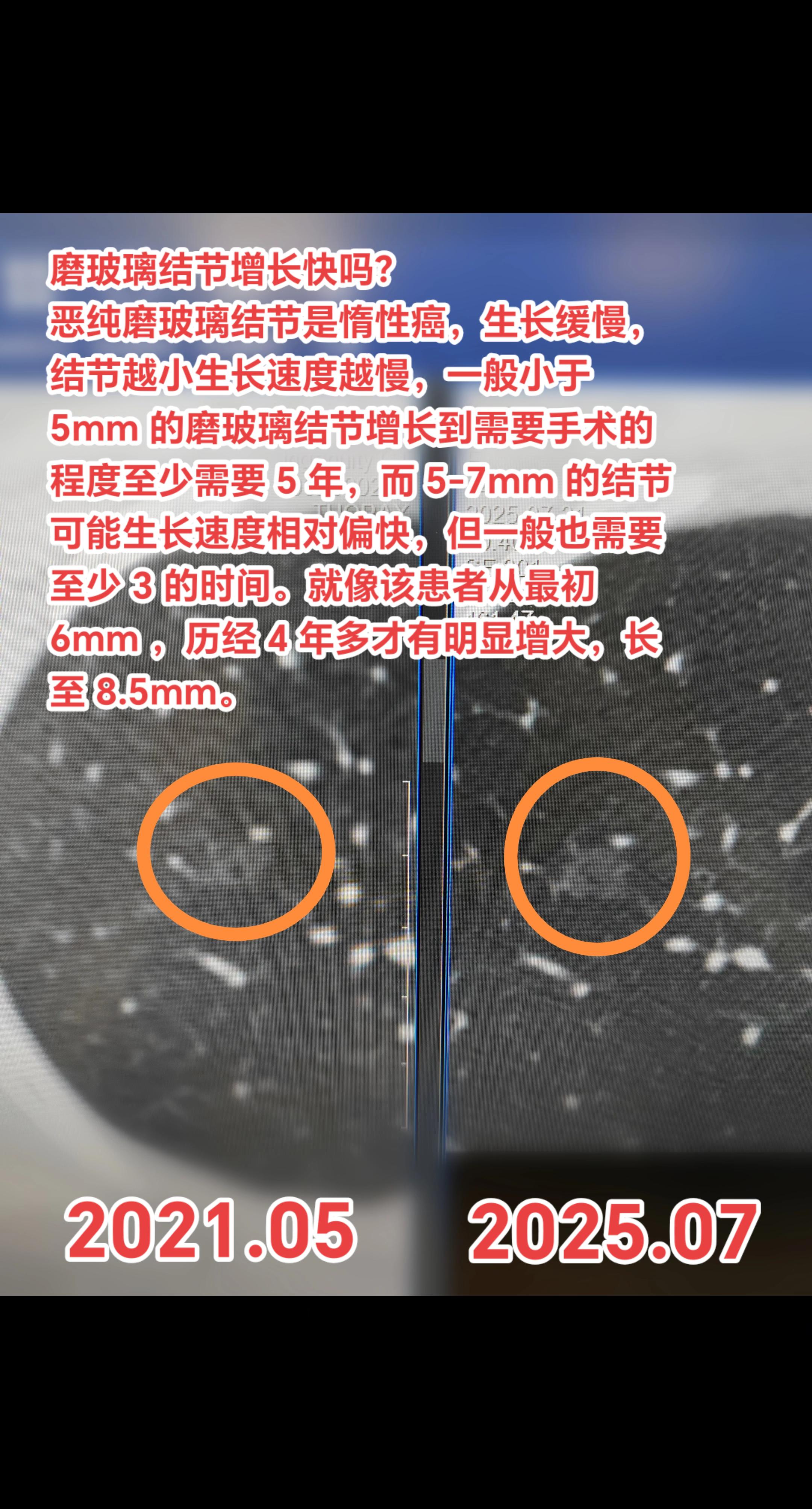 恶性磨玻璃结节增长快吗？恶纯磨玻璃结节是惰性癌，生长缓慢，结节越小生长...