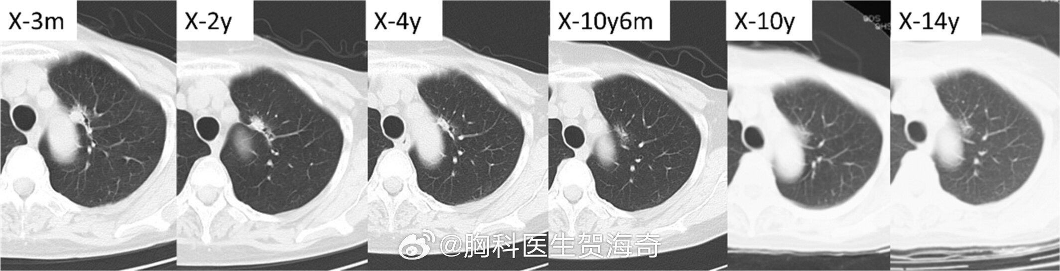 #肺结节[超话]# 近日，日本医生报道了一例肺磨玻璃结节发展为中晚期肺癌的案例。