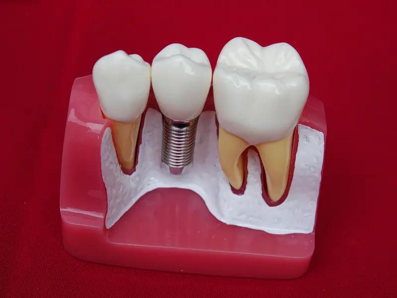 种植牙的寿命是多久? 种植牙寿命这事儿，得好好唠唠。理论上，种植牙能终身使用。全