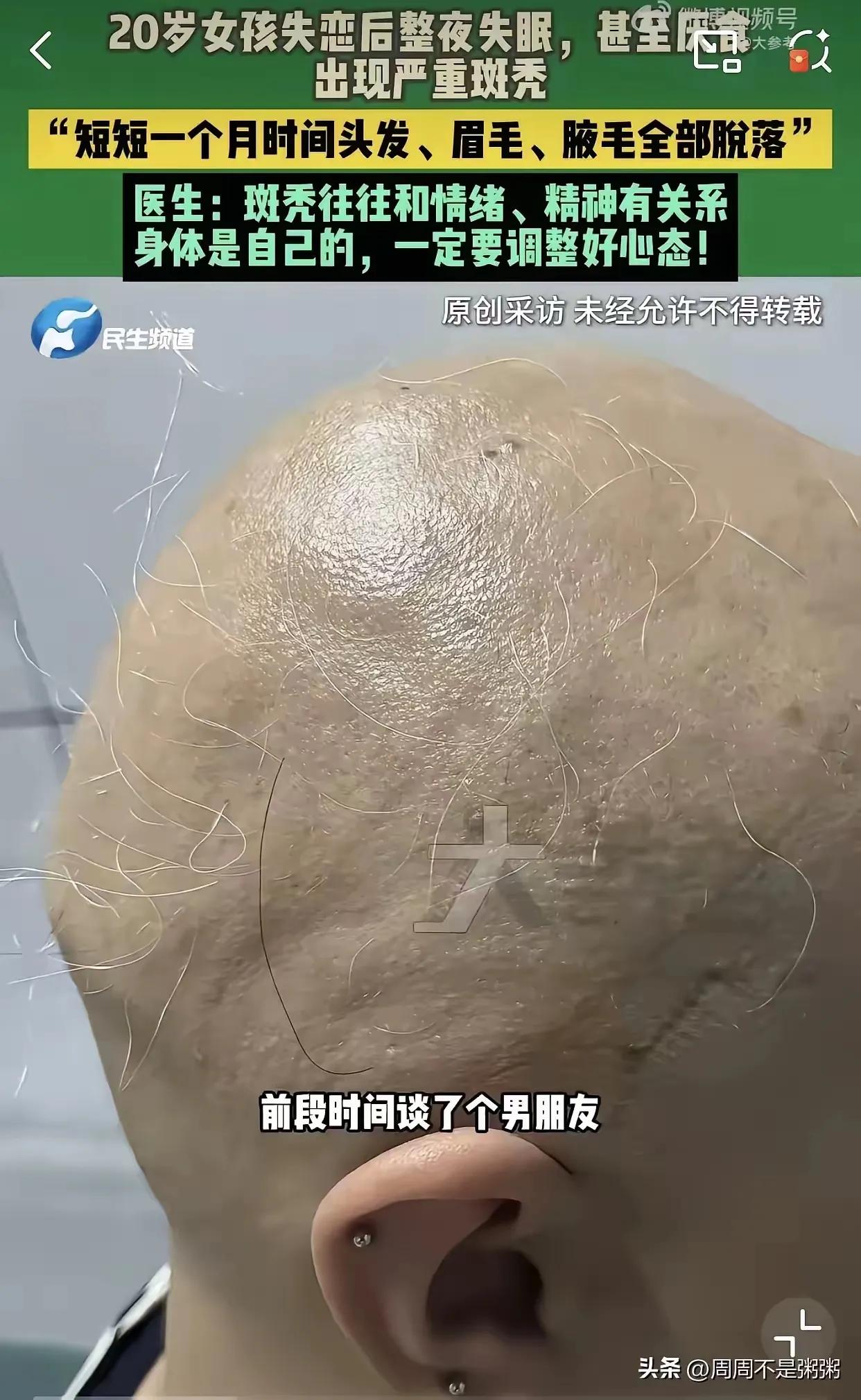 这篇文章讲述了一个真实的心理和身体健康事件，展现了情感创伤对身体的深远影响。我们