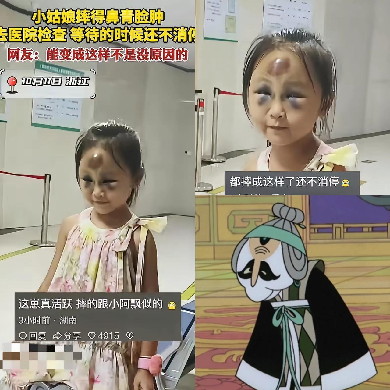 是心疼还是笑？浙江这个小姑娘摔得也太有“造型感”了，额头、眼下青一块紫一块，都快