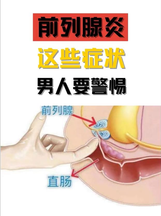 前列腺炎这些症状，男人要警惕！