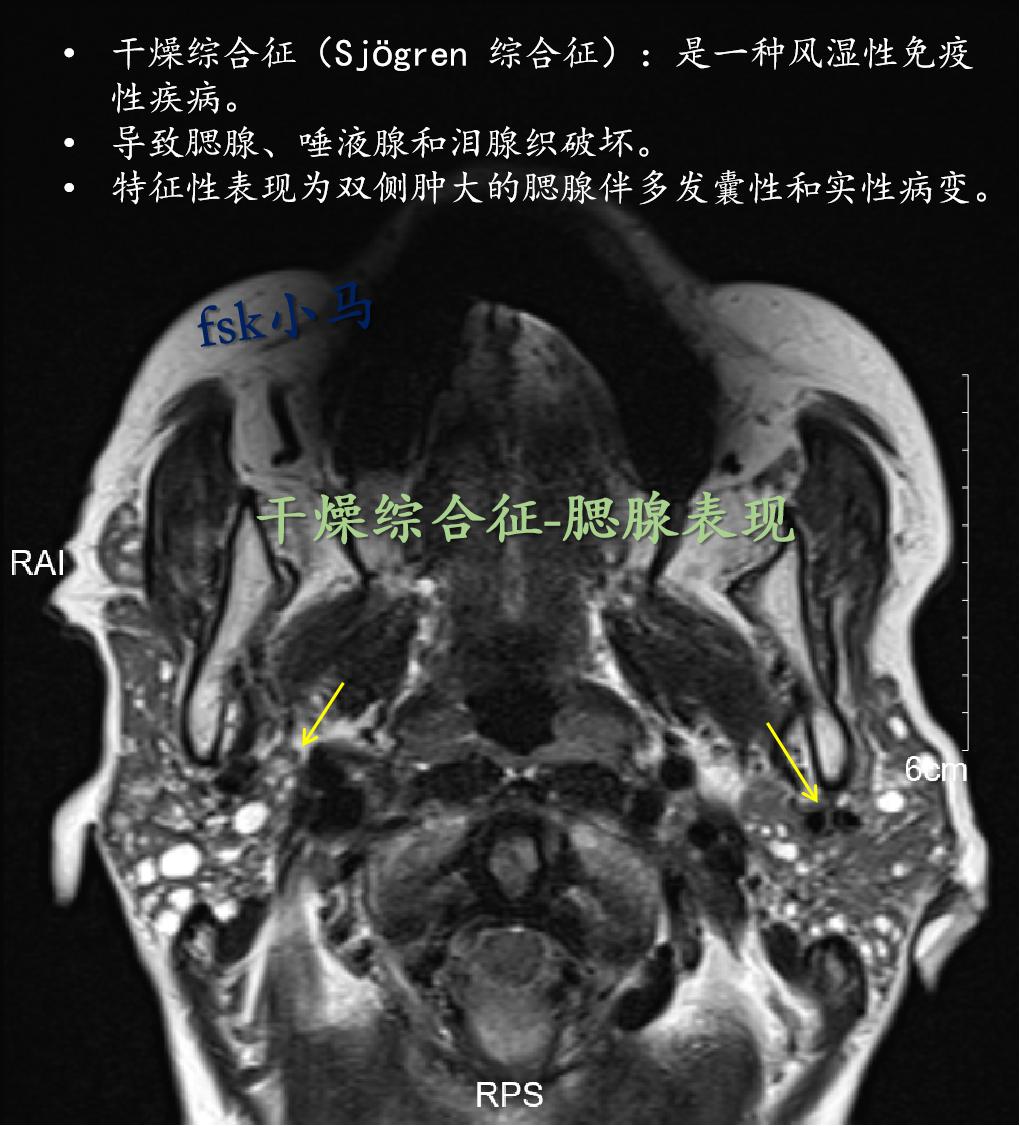 干燥综合征（Sjӧgren 综合征）：是一种风湿性免疫性疾病，特点是外...