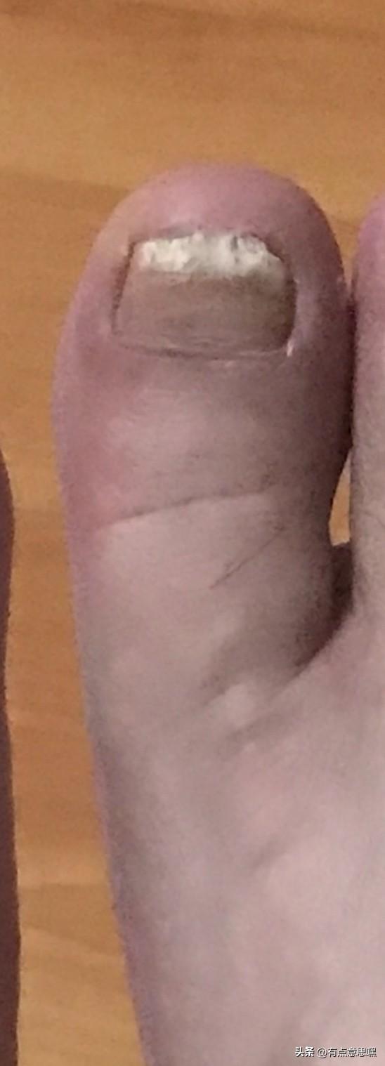 分享一个治疗灰趾甲的小偏方，保真

十几年前踢球，不小心右脚大拇趾趾甲盖受伤，因