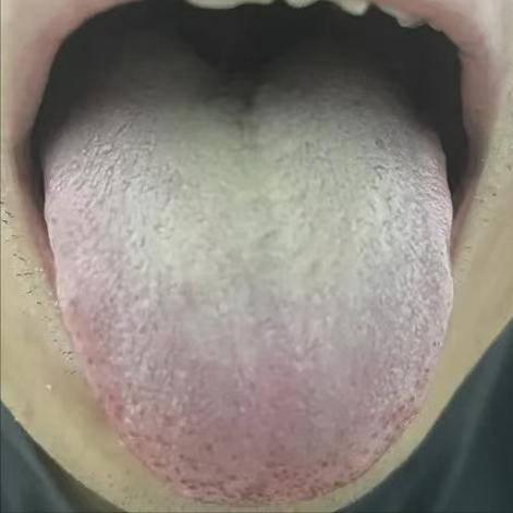 尤其40岁后这里狂出汗要当心！这种舌头是“湿热报警器”！

患者主诉：大腿根出汗
