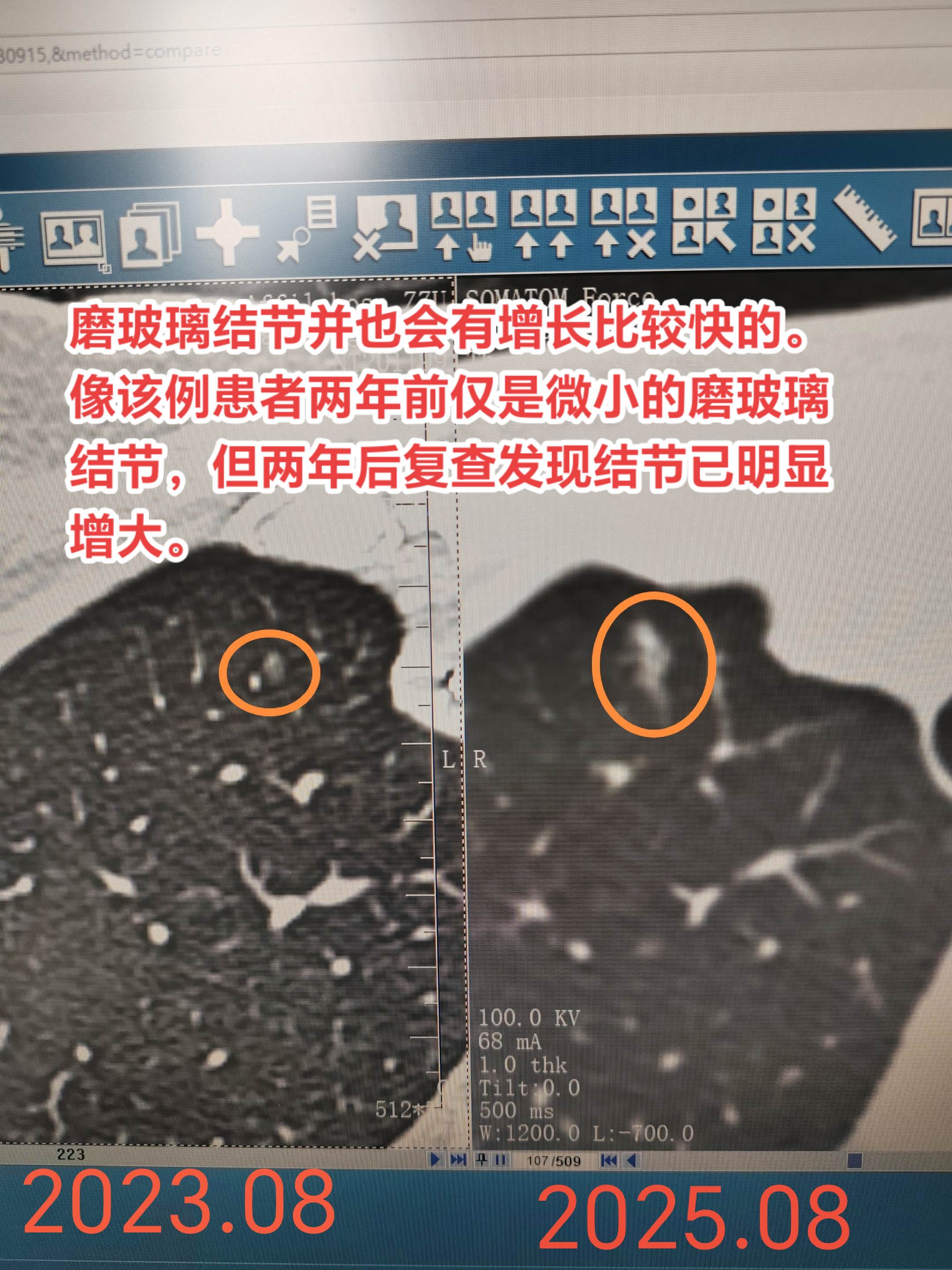磨玻璃结节并也会有增长比较快的。像该例患者两年前仅是微小的磨玻璃结节...