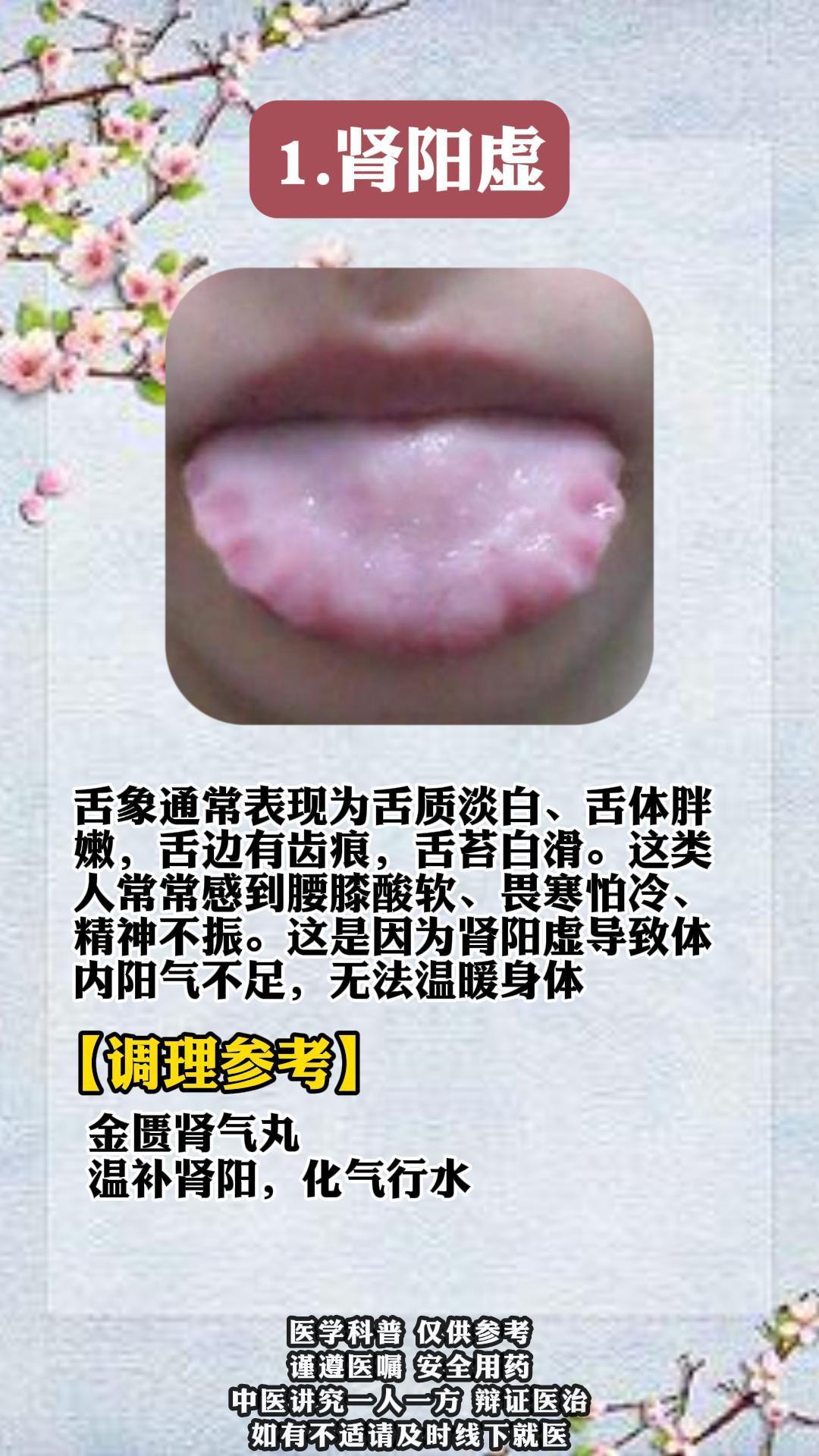 肾虚的人，其实从舌象上就能一眼看出来
1.肾阳虚
舌象通常表现为舌质淡白、舌体胖嫩，舌边有齿痕，舌苔白滑。这类人常常感到腰膝酸软、畏寒怕冷、精神不振。这是因为肾阳虚导致体内阳气不足，无法温暖身体
【调理参考】
金匮肾气丸
温补肾阳，化气行水
 
2.肾阴虚
舌象通常表现为舌质红、舌体瘦小，舌苔少或无苔。这类人常常感到头晕耳鸣、潮热盗汗、口燥咽干。这是因为肾阴虚导致体内阴液不足，无法滋养身体
【调理参考】
六味地黄丸
滋阴补肾
 
3.肾气虚
舌象可能表现为舌质淡、舌体略胖，舌苔薄白。这类人常常感到气短乏力