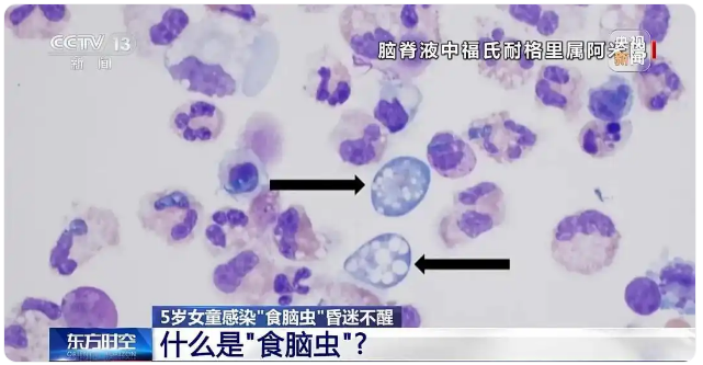 一月两起“食脑虫”夺命悲剧 玩水如何避开致命威胁？