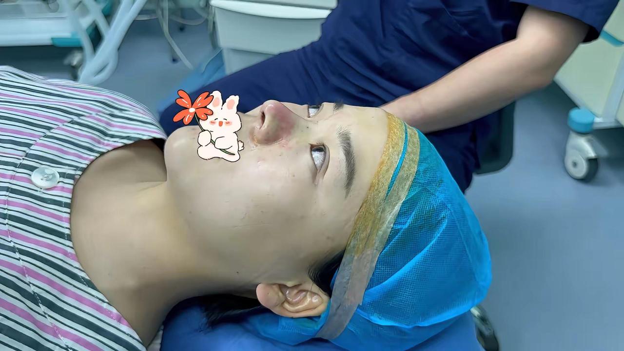 无假体隆鼻，短鼻延长，保留鼻术式真实案例。短鼻 拯救塌鼻梁  做完鼻子后的改变 