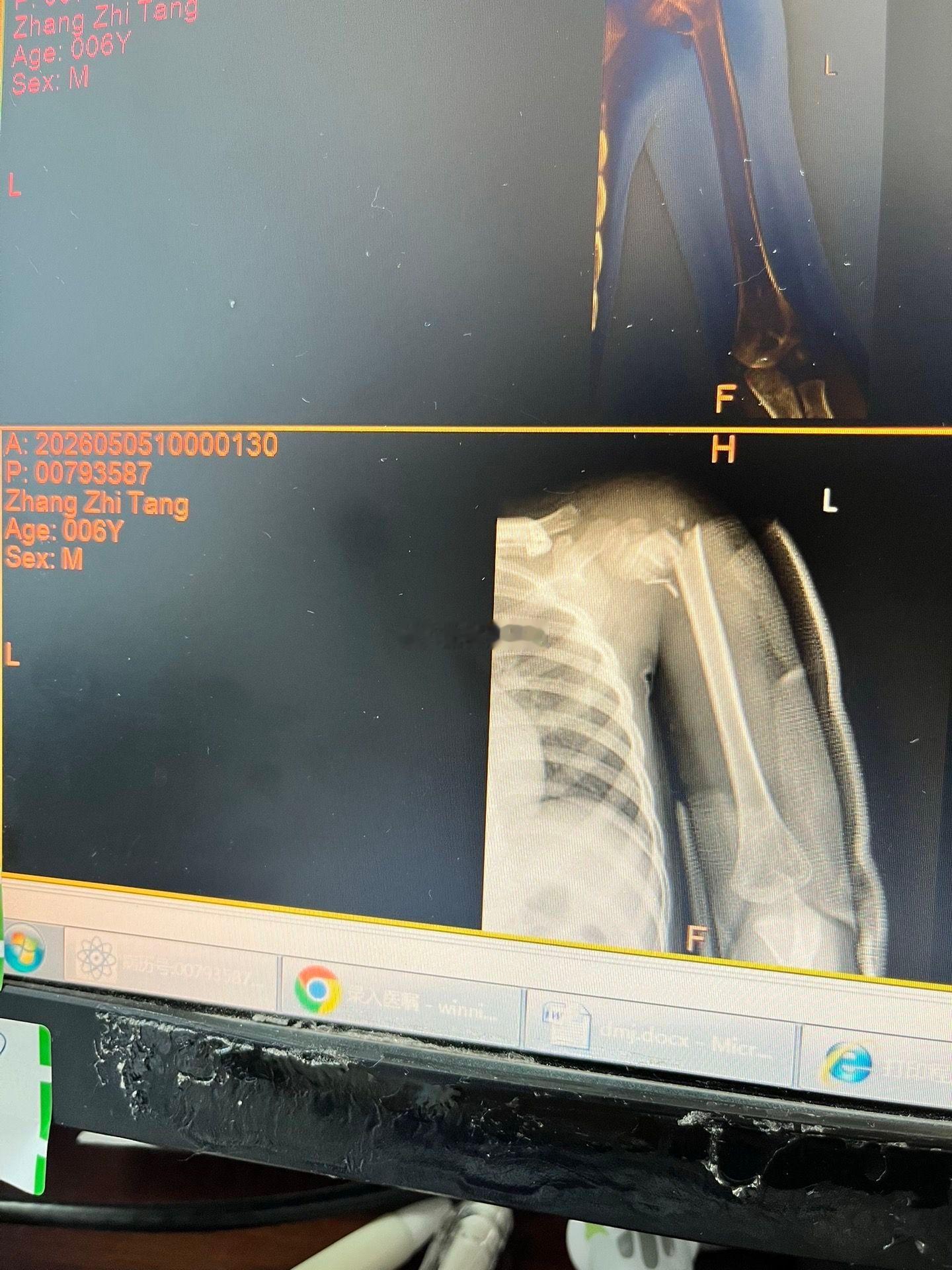 两男童玩耍时坠入小区人防竖井，一男童重伤开颅已昏迷9天仍在ICU，母亲：孩子才6