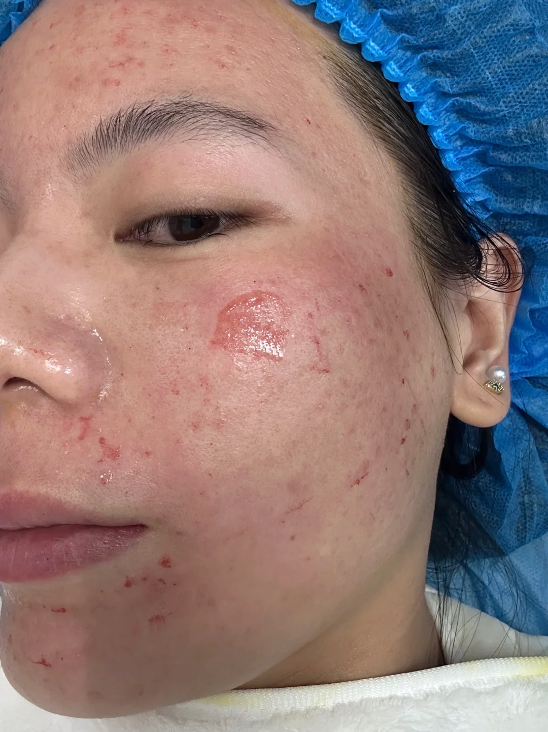 痘肌西安2次黄金微针，要做的看这篇！