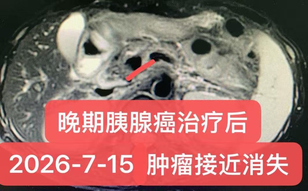 晚期胰腺癌的挽救治疗。男性，40岁。诊断：胰头恶性肿瘤（转移性胰腺腺泡...