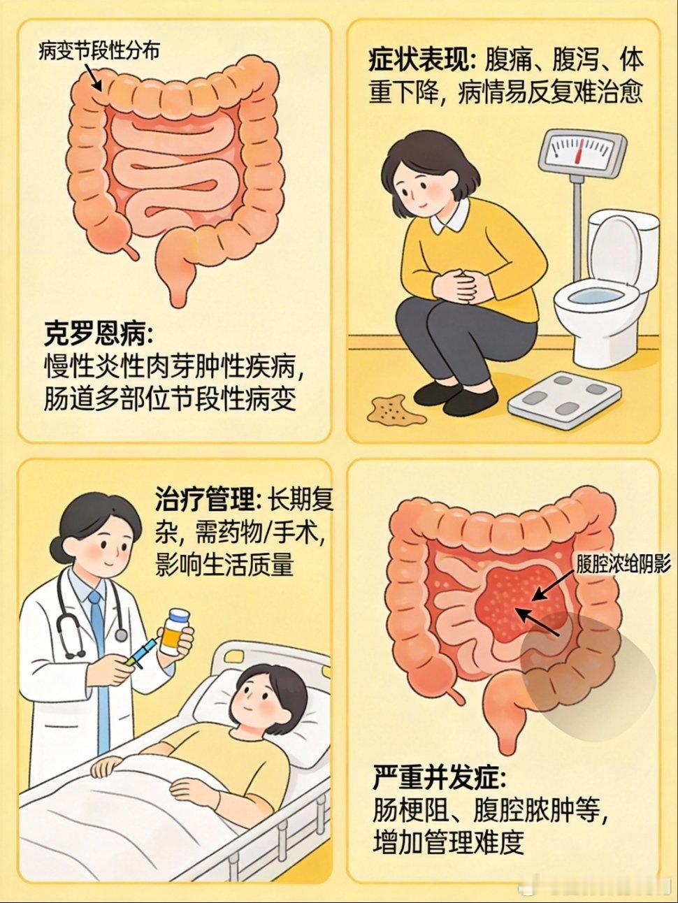 不明原因腹泻小心克罗恩病世界炎症性肠病日健闻登顶计划 克罗恩病属于慢性免疫性肠病