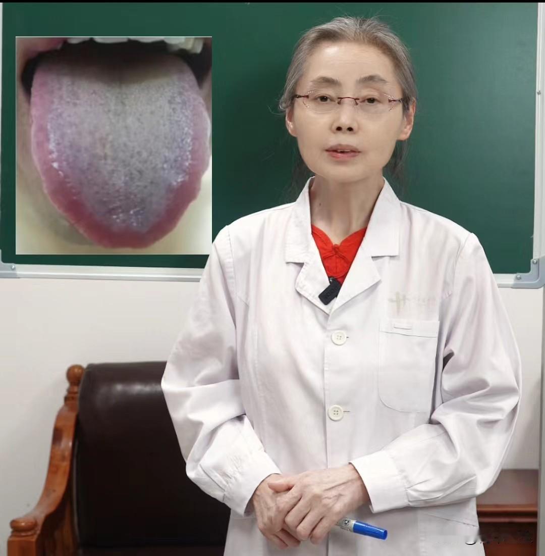 这种黄腻苔，千万不要直接进补，别怪我没提醒你

中医看舌象呢，讲究的是一看舌苔，