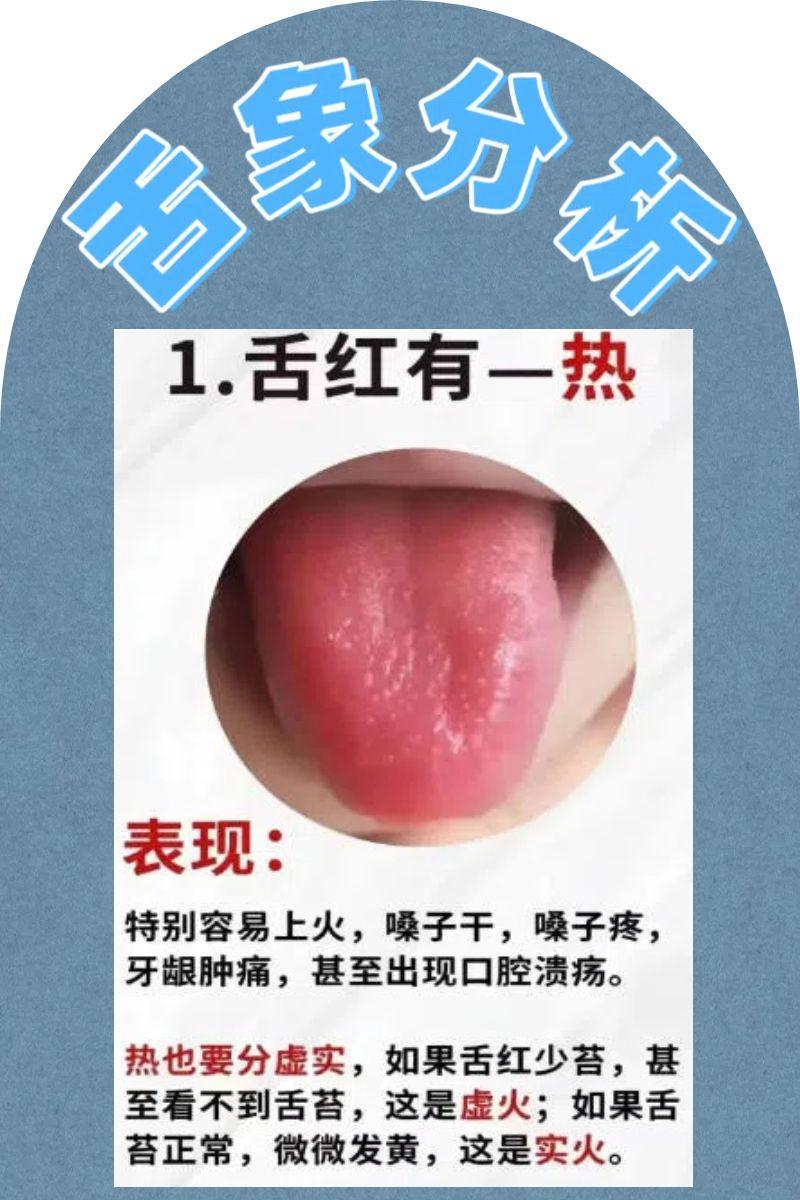 今天的舌诊分享——四种常见舌象，看看你是哪一种？

1，舌红——有热邪
表现：口