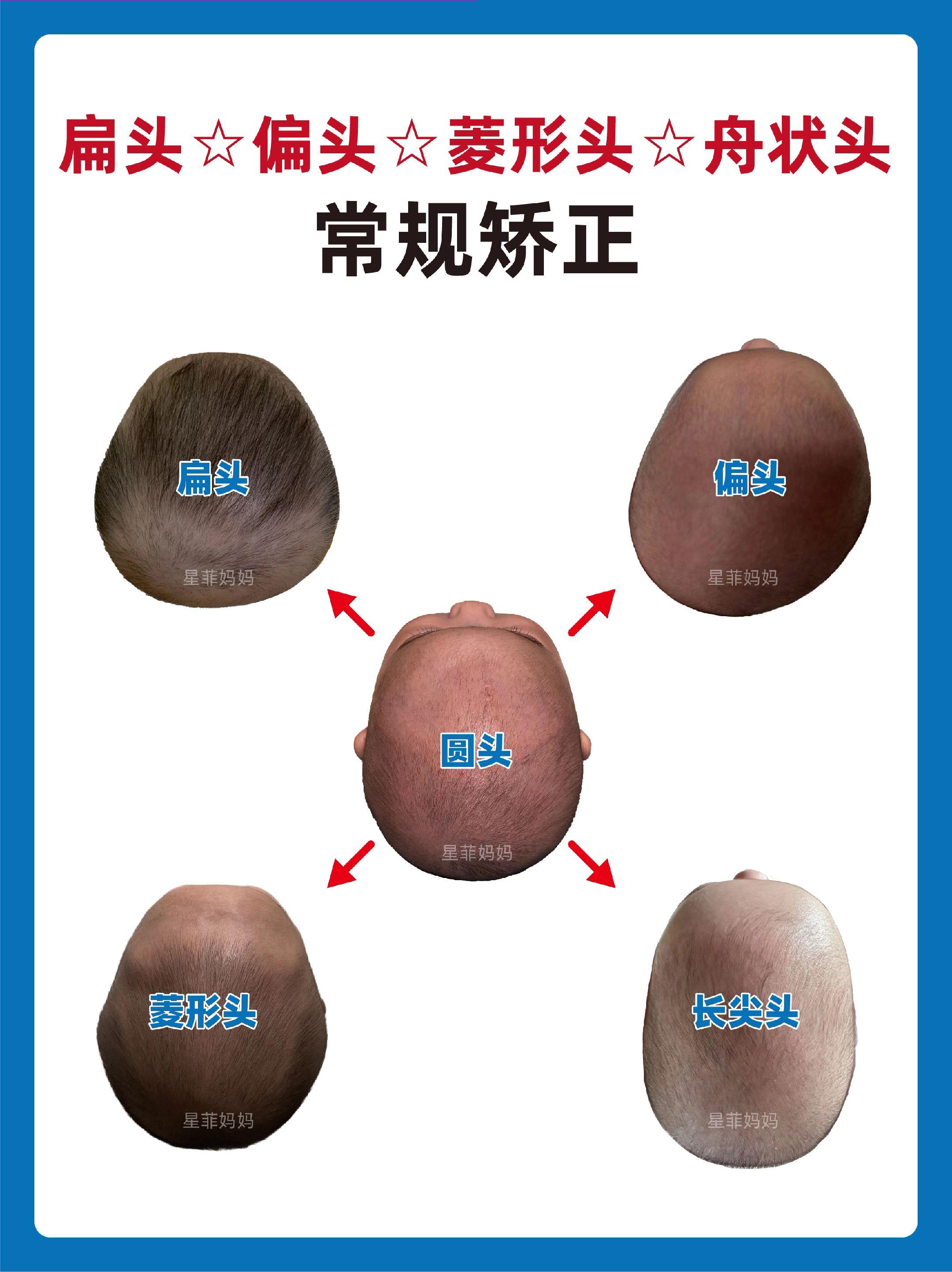 宝宝头型|简单清晰讲清楚四大头型睡圆头。