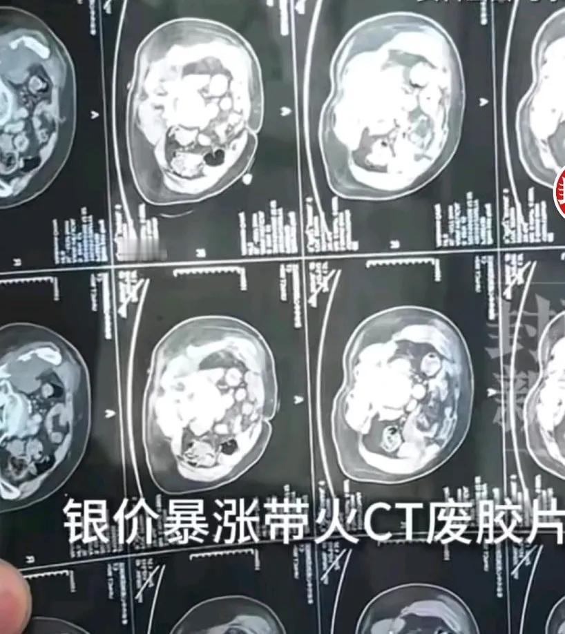 银价暴涨带火CT废胶片，回收商称价格翻倍，目前0.6元每张，医疗影像废胶片可提取