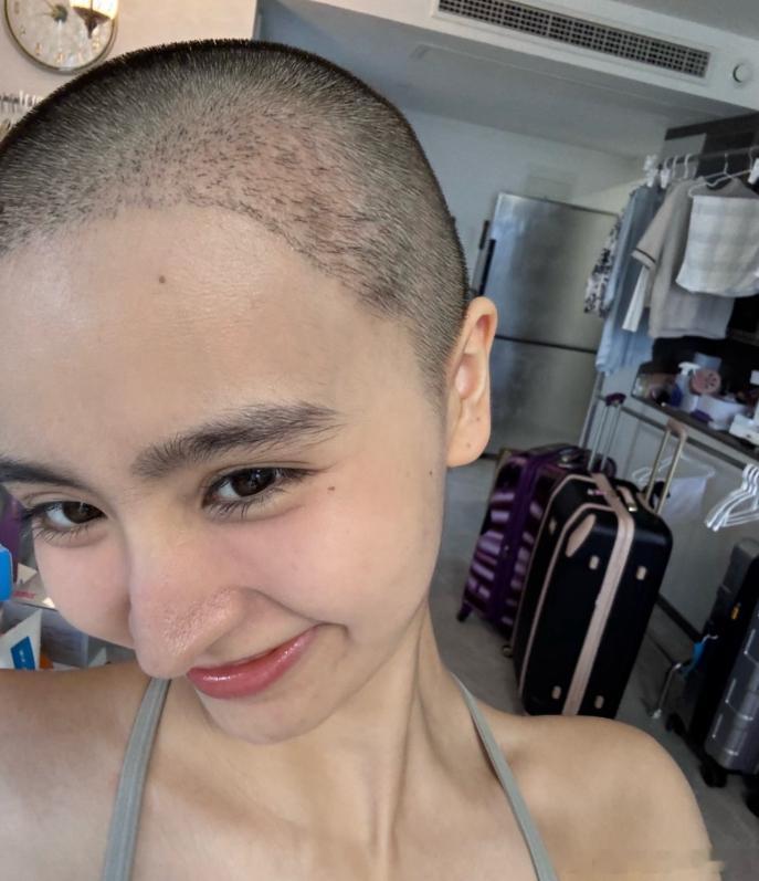 讨论金子涵的发际线，她通过植发进行调整，这是个人对形象的合理追求，没有夸张成分，