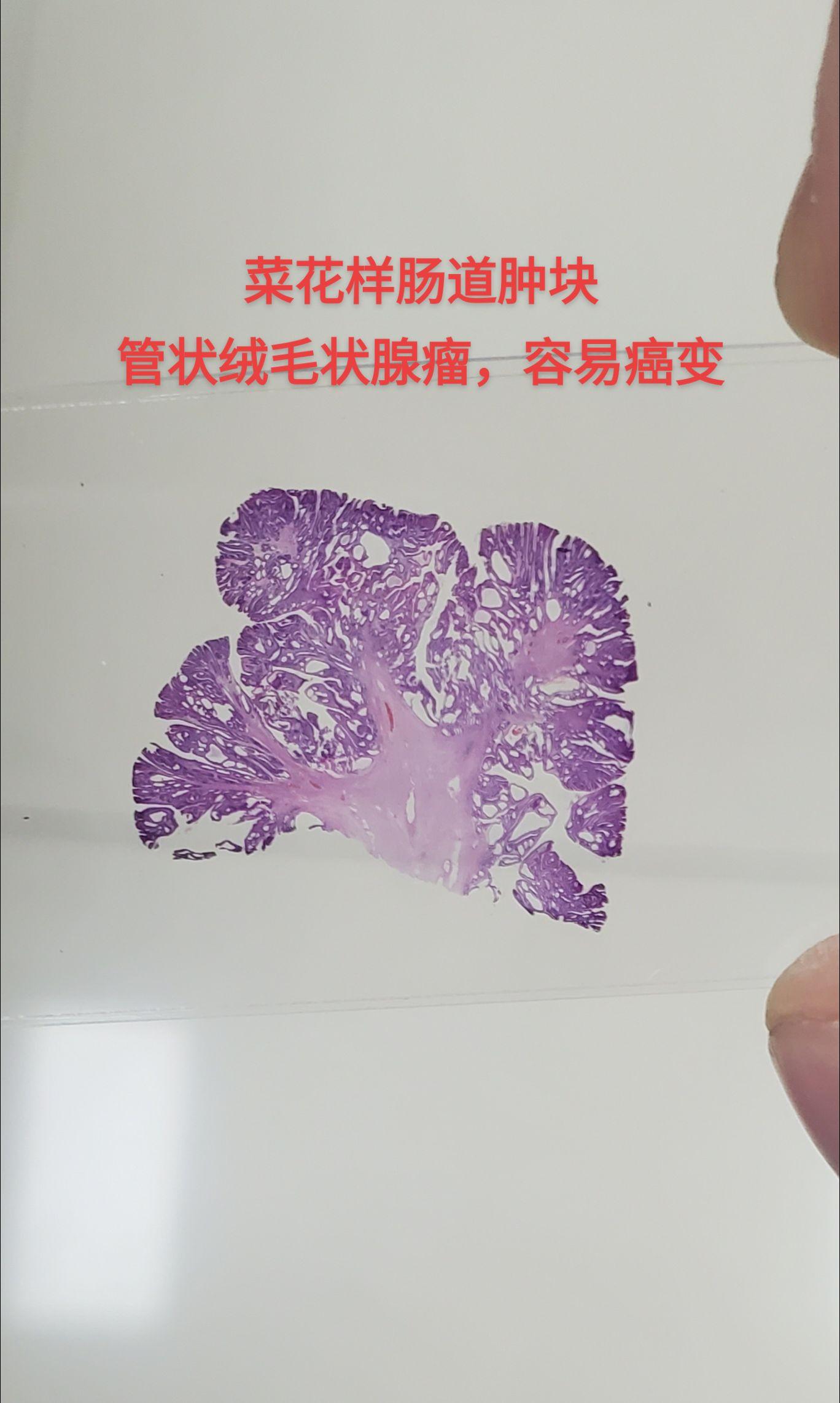 肠息肉 管状绒毛状腺瘤