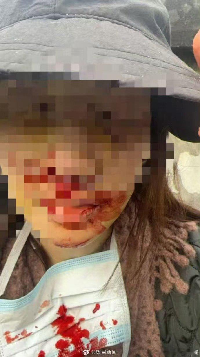 金晨撞车后脸部受伤金晨撞车后脸部受伤，看起来还挺严重的，所以先离开去医院也情有可