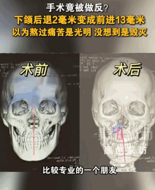 万万没想到！湖北武汉，24 岁女子躺上手术台，计划依靠微调改善颌面细微瑕疵。熬过