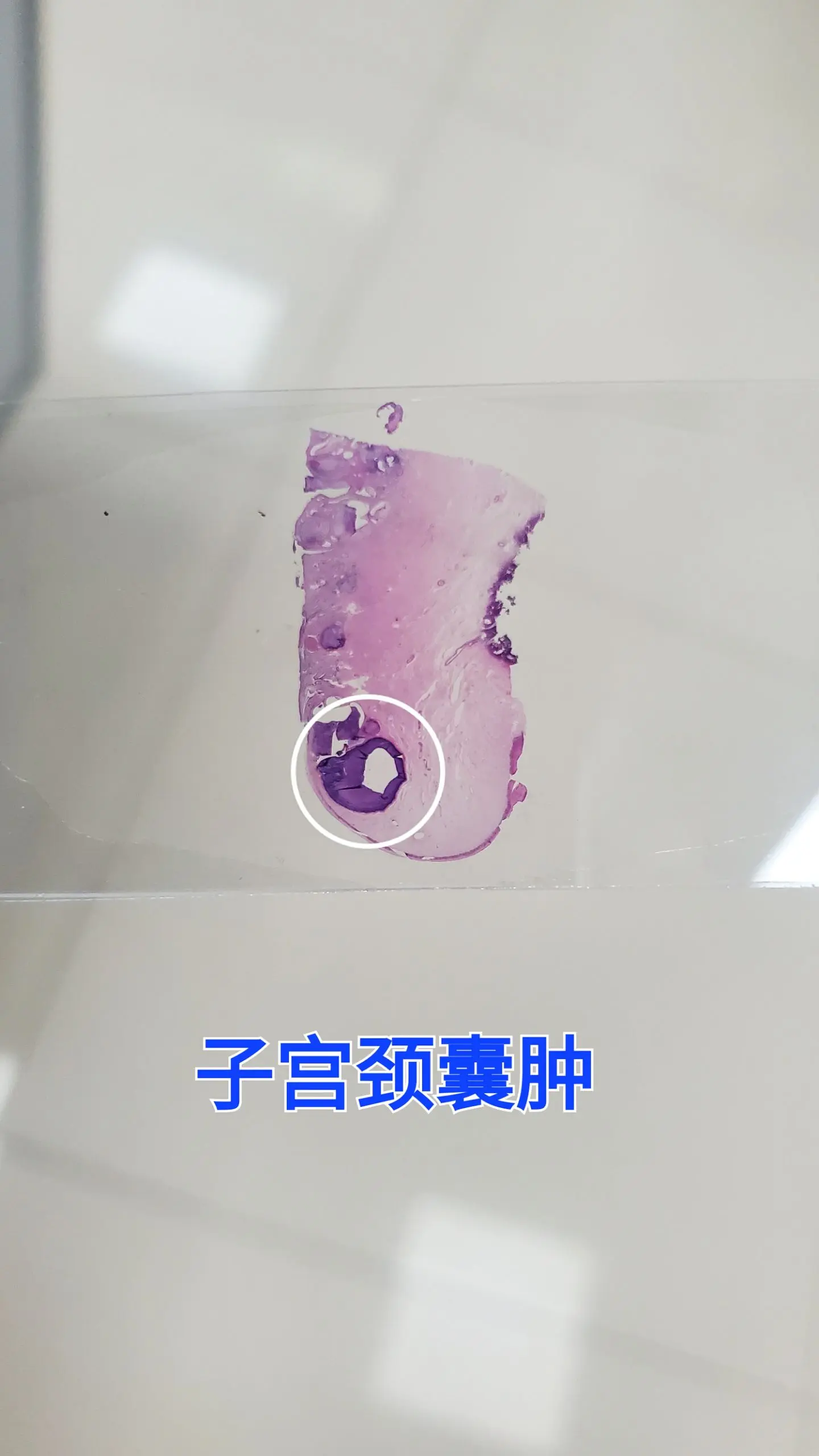 子宫颈囊肿
