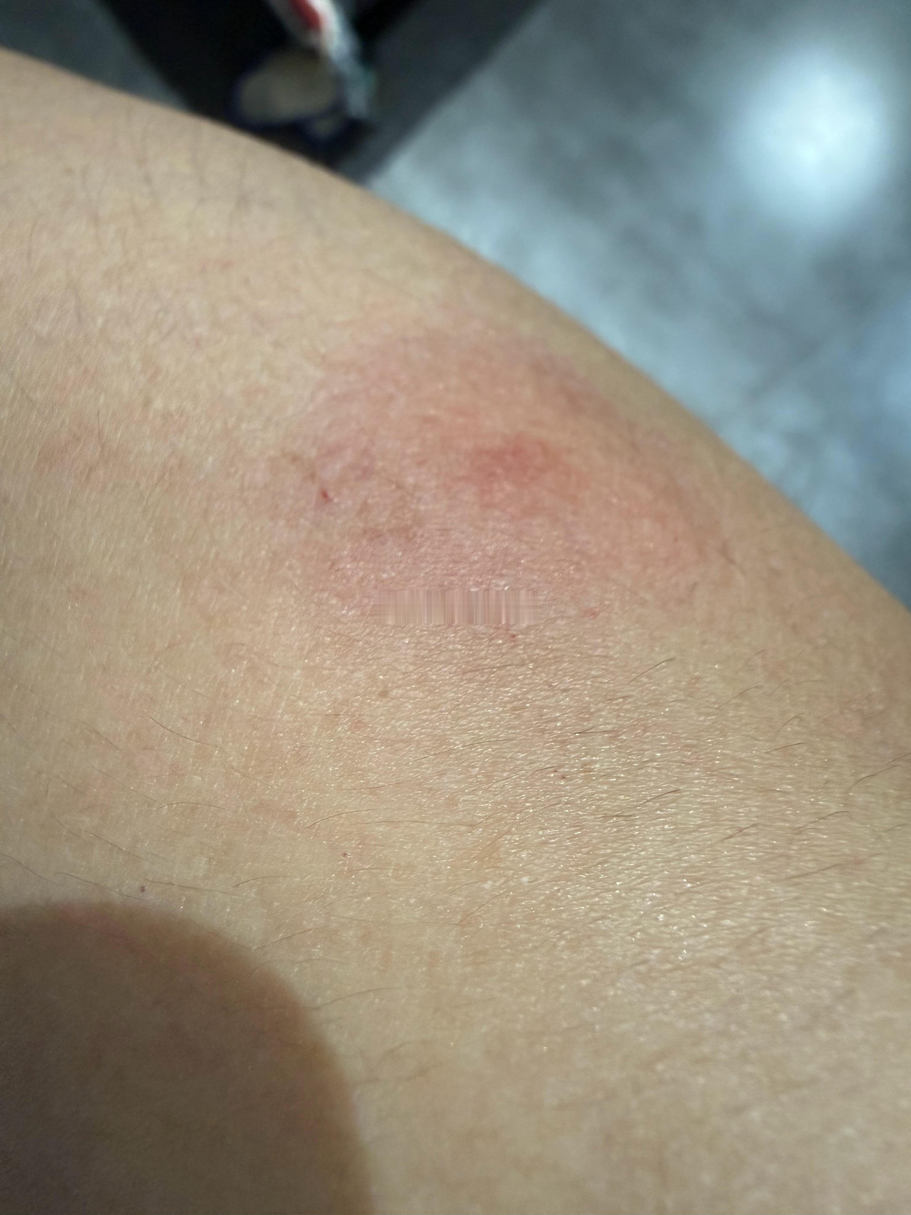 跟蚊子的仇真的是不共戴天了！又咬了我三口！