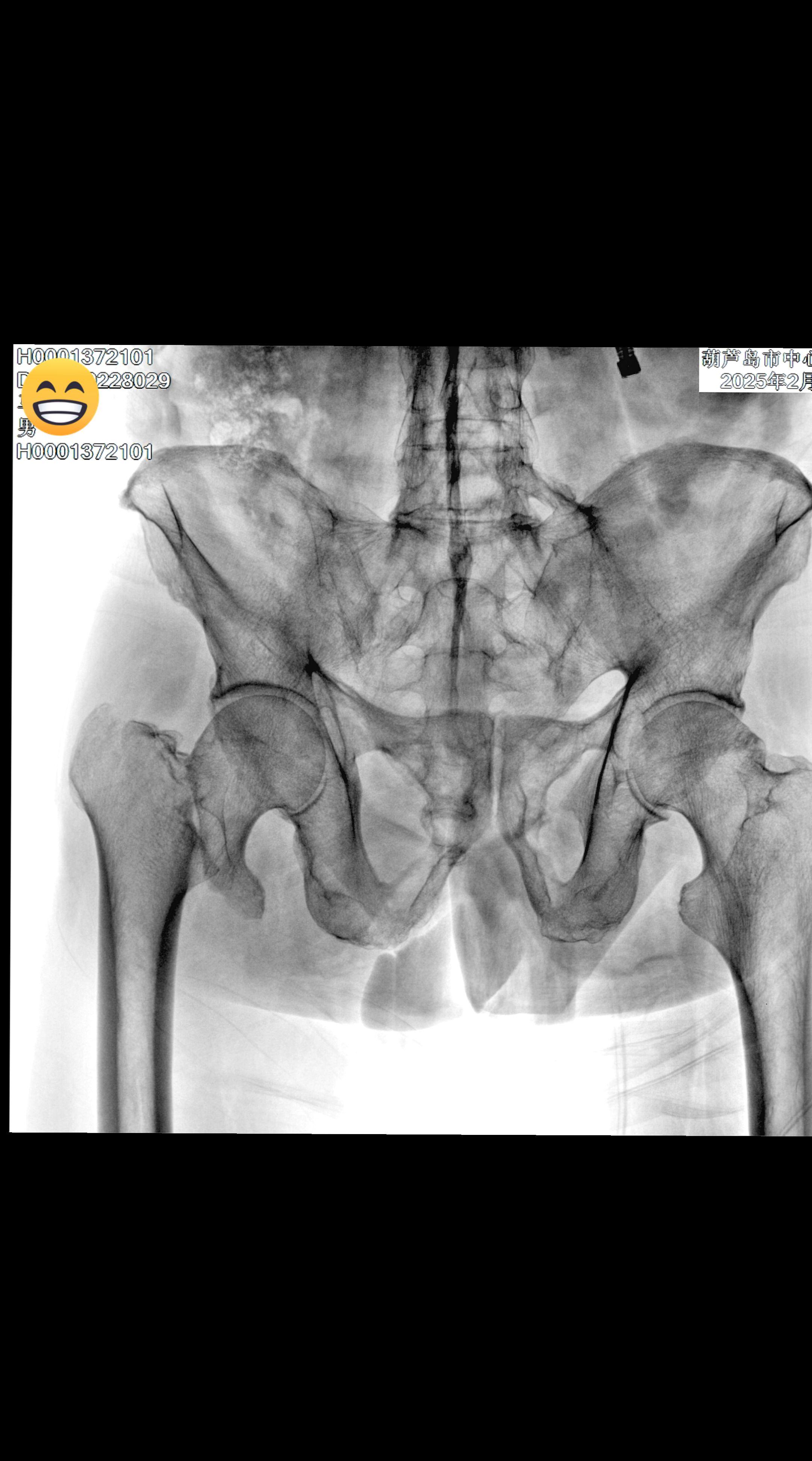 臭名昭著的二分小转子，牵引床上骨钩辅助复位，Intertan内固定，坚...