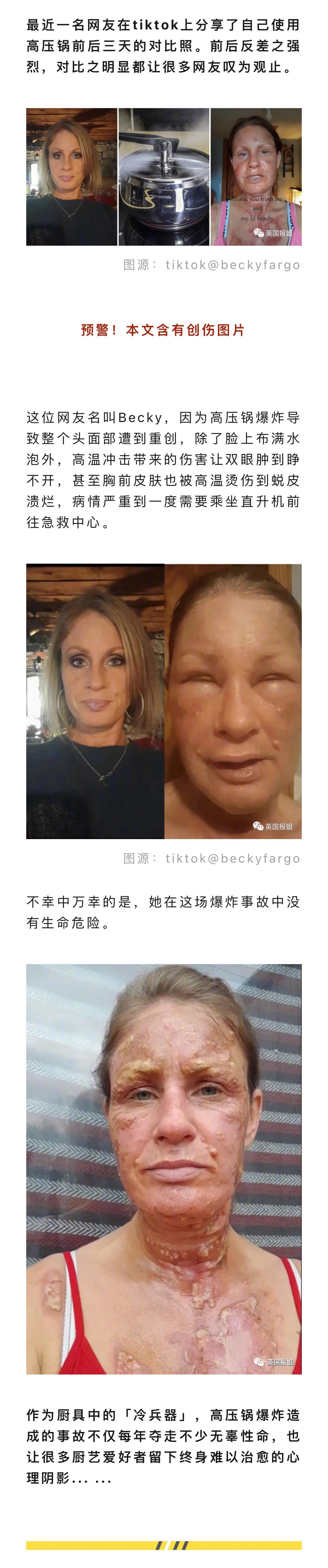 美国女子用高压锅时发生爆炸，头面部皮肤水泡遍布，面目全非不敢认。网友们纷纷讲述自