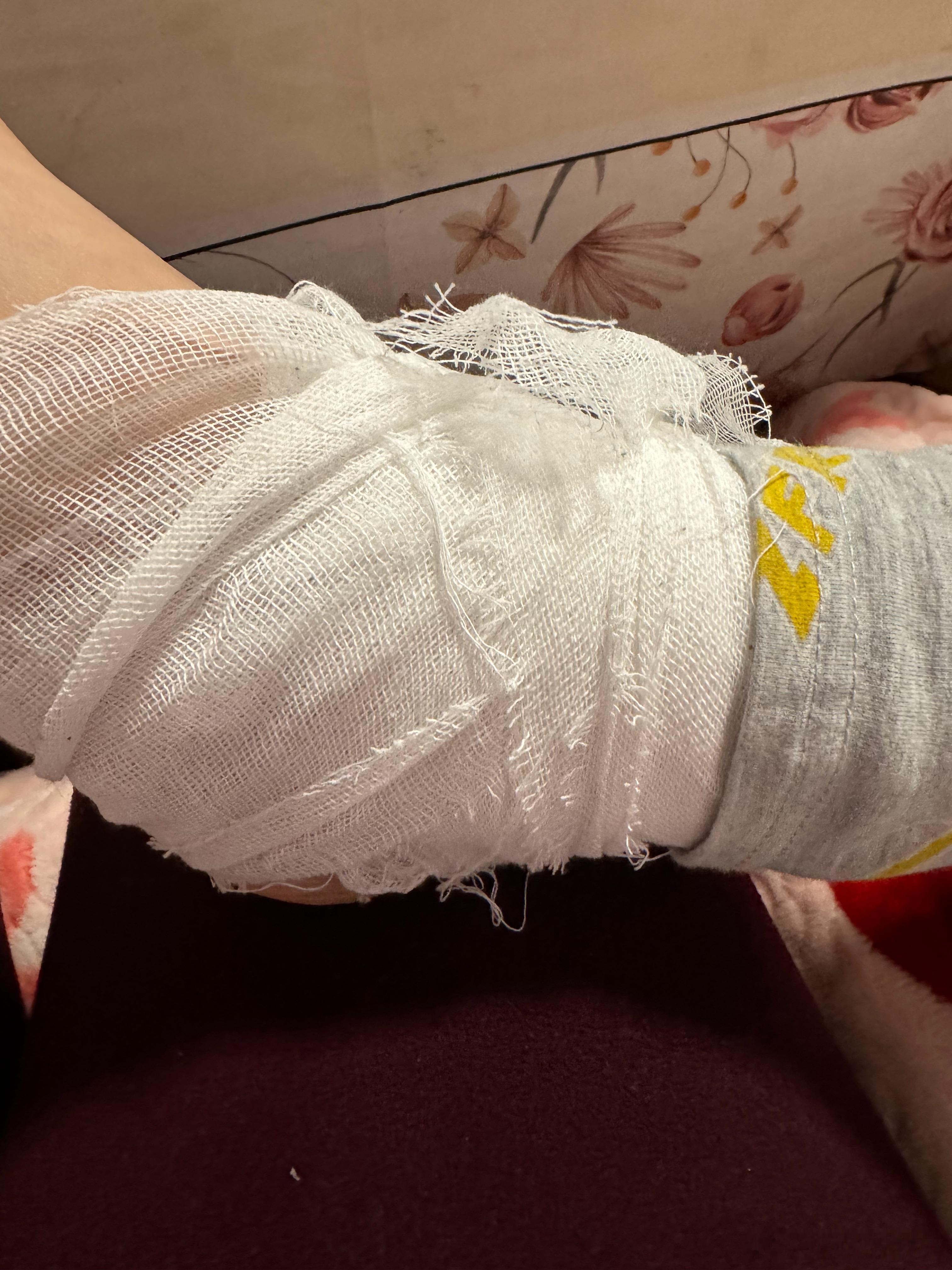 周二说右膝盖疼  周四说左脚腕疼  然后嗯 左脚腕韧带拉伤的小盆友喜提绷带固定（