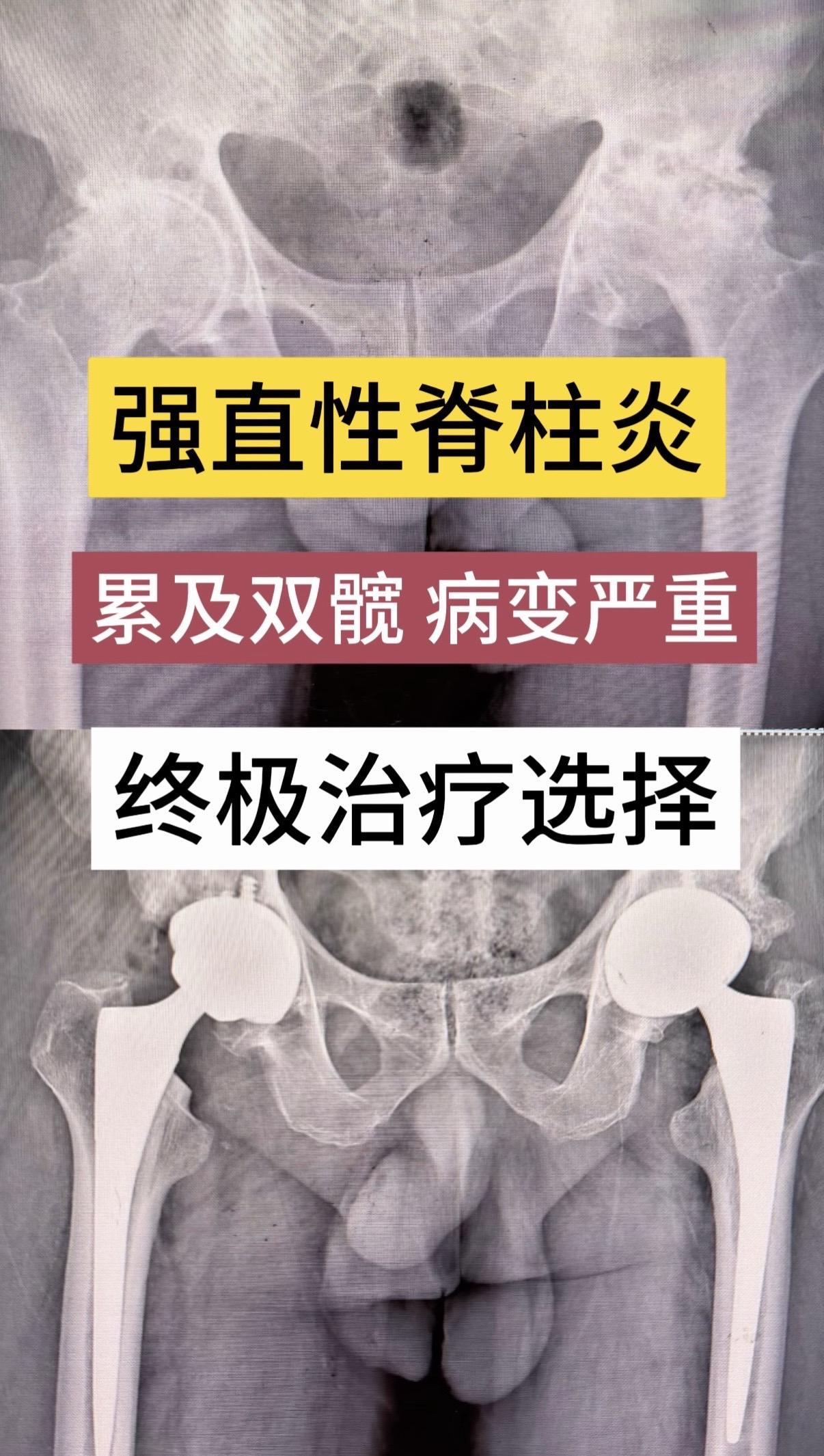 强直性脊柱炎累及双髋，病变严重的终极治疗。60岁男性患者，强直性脊柱炎...