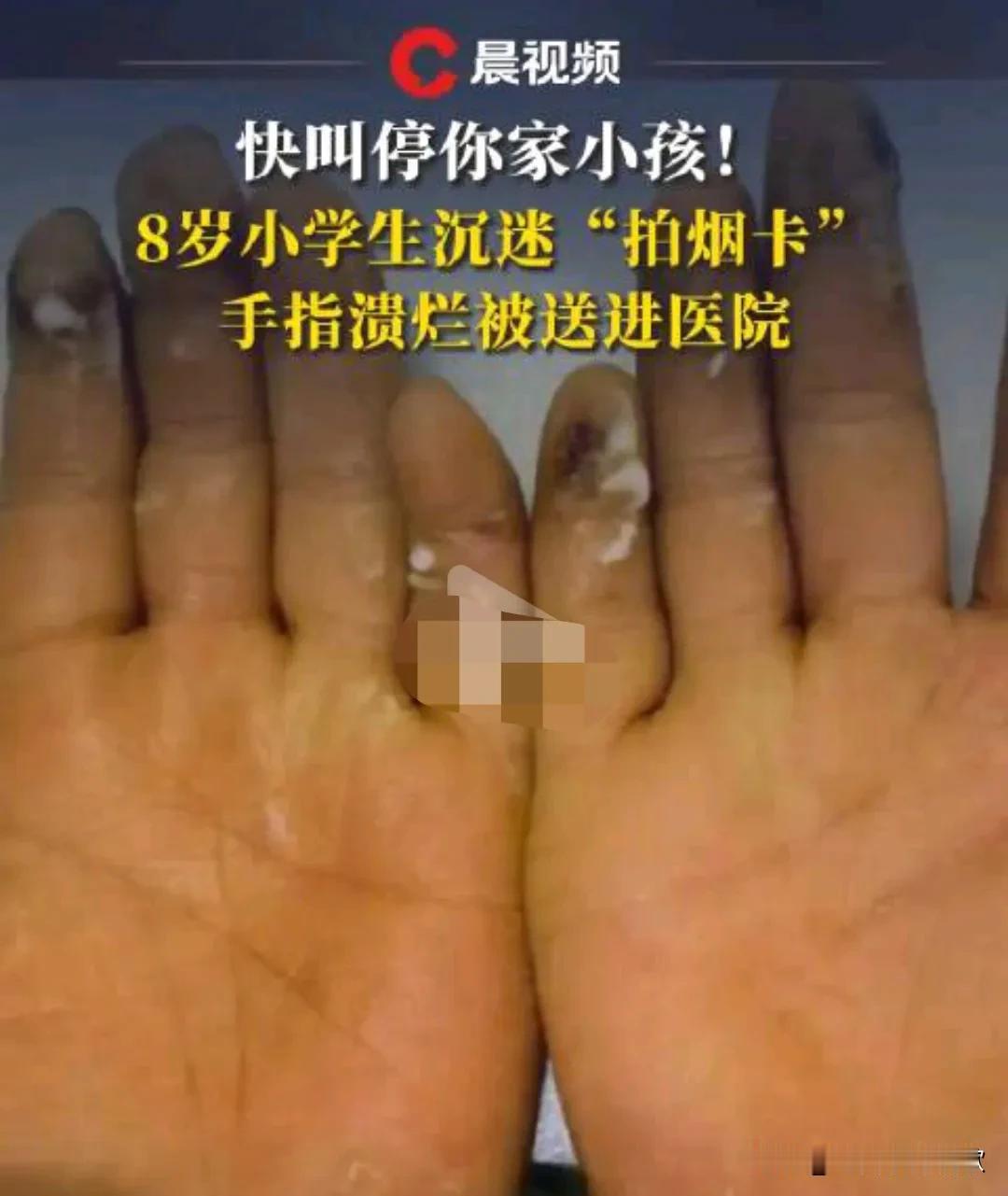 家长们注意了。这真是太不可思议了，想不到拍烟卡，能把手拍成这样。
11月19日潇