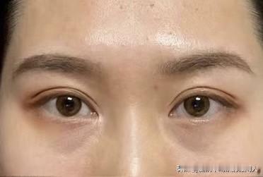 昨天去美容中心做脸部护理时帮我做护理的小姐姐不停的对我说我的眼袋有点大，向我推荐