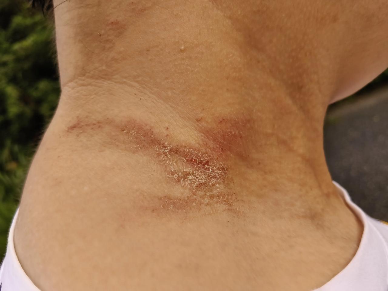 这种病太痛苦了，你们知道不知道太阳晒成这样，用什么药有效啊？
